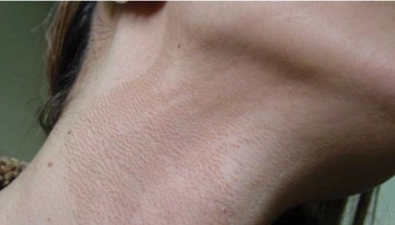 Ensede Kaşıntı Belirtileri ve Tedavisi