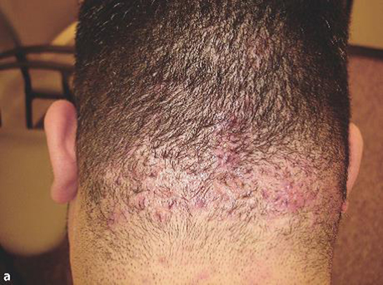 Ense Kılları Özellikleri ve Faydaları Nelerdir?