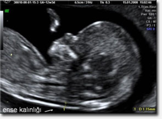 Gebelikte Ense Kalınlığı Kaç Olmalı?