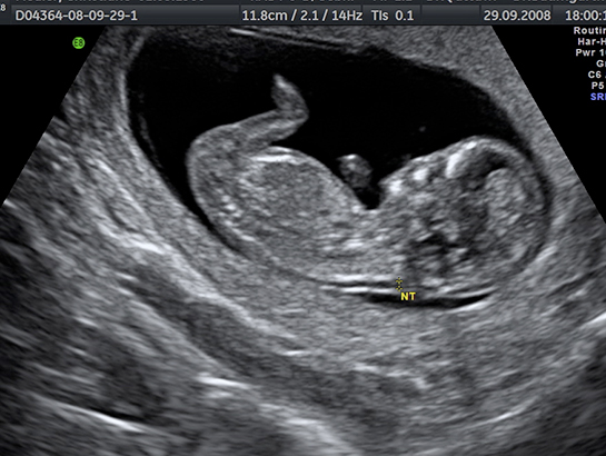 Hamilelikte Ense Kalınlığı